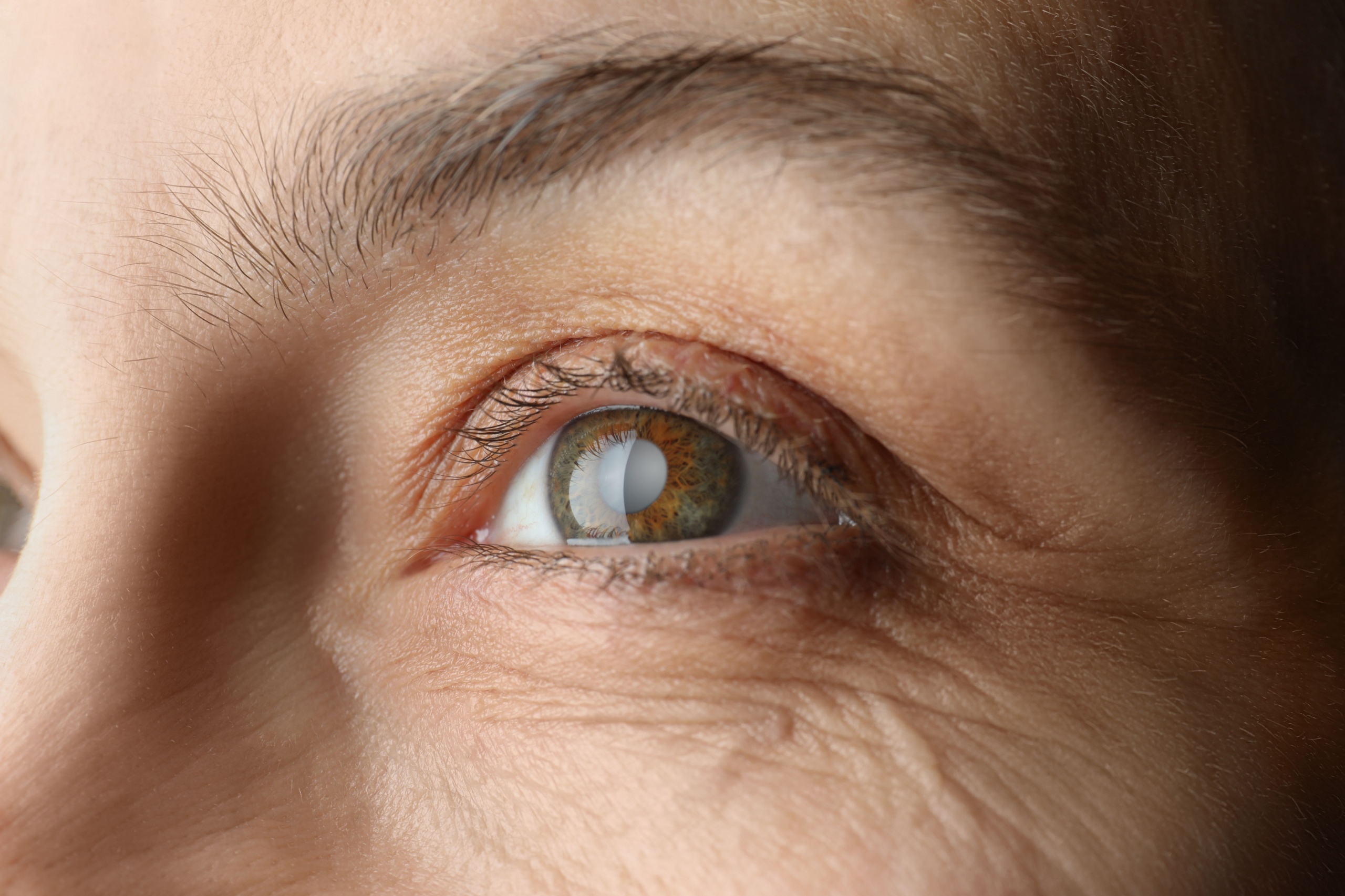 Can Cataracts Come Back After Surgery?